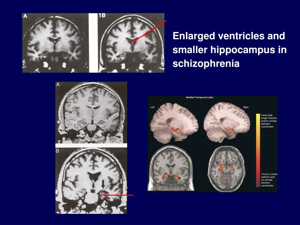 enlarged ventricles and smaller hippocampus