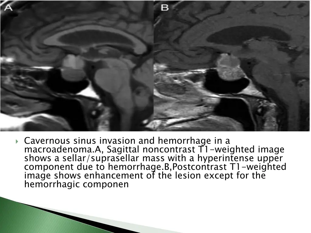 cavernous sinus invasion and hemorrhage