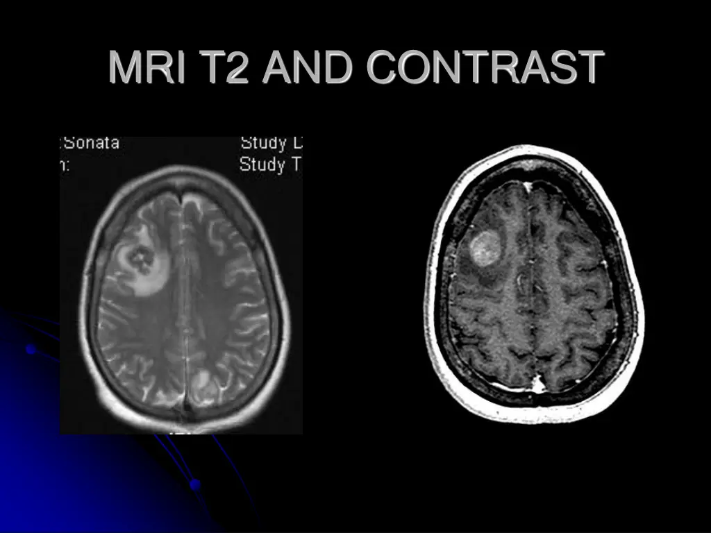 mri t2 and contrast