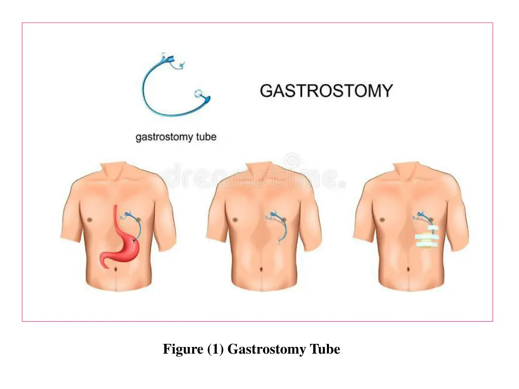 figure 1 gastrostomy tube