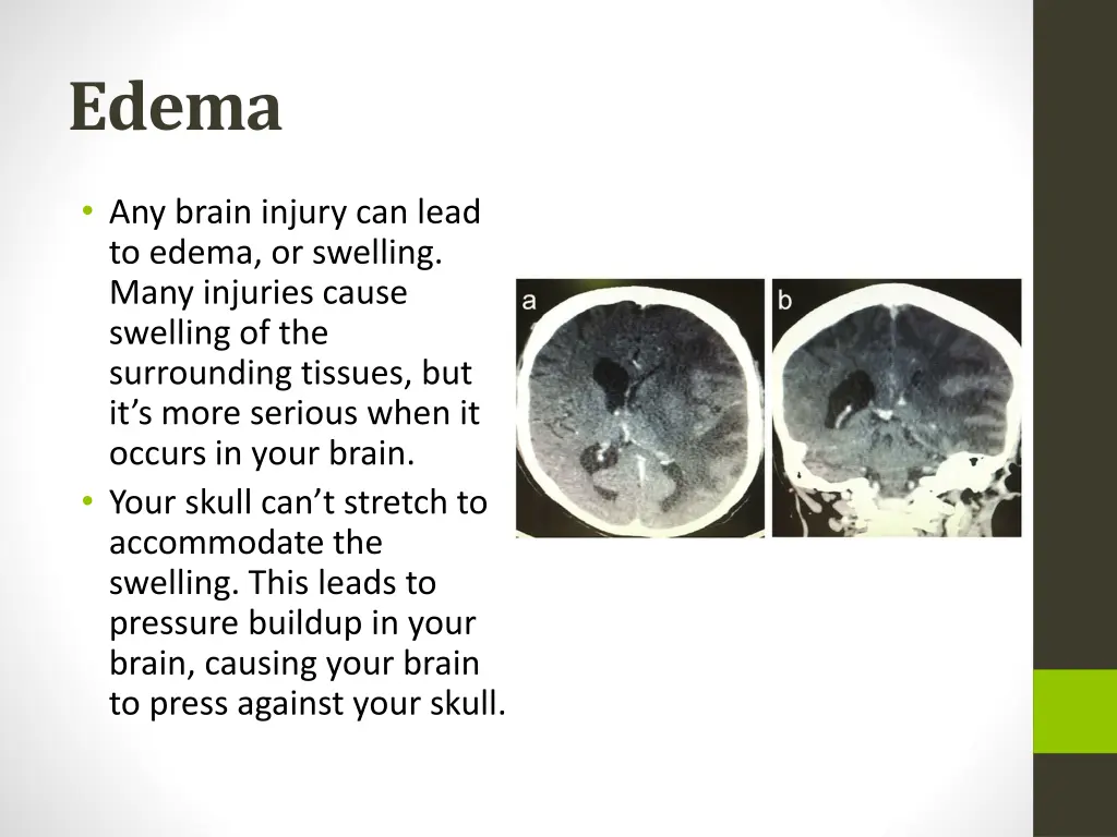 edema