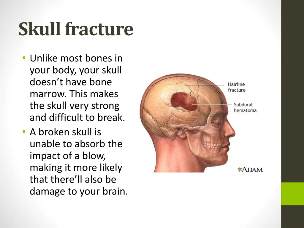 skull fracture
