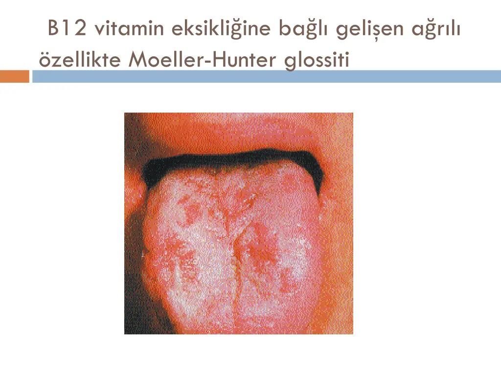 b12 vitamin eksikli ine ba l geli