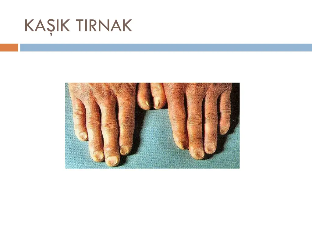 ka ik tirnak