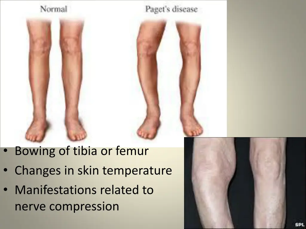 bowing of tibia or femur changes in skin