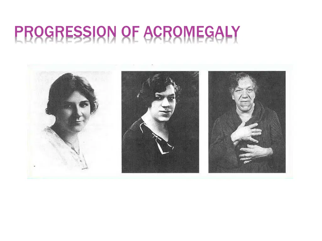 progression of acromegaly 1