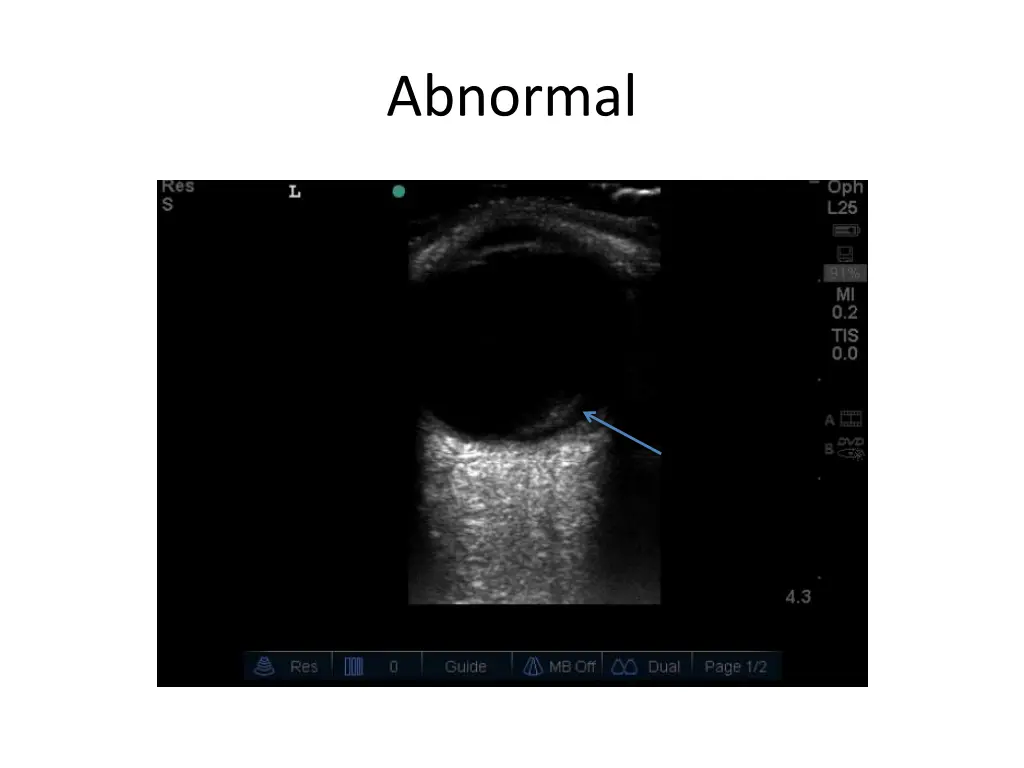 abnormal 3