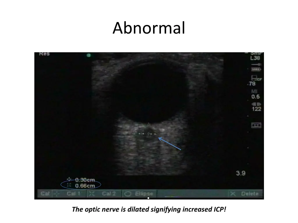 abnormal 4