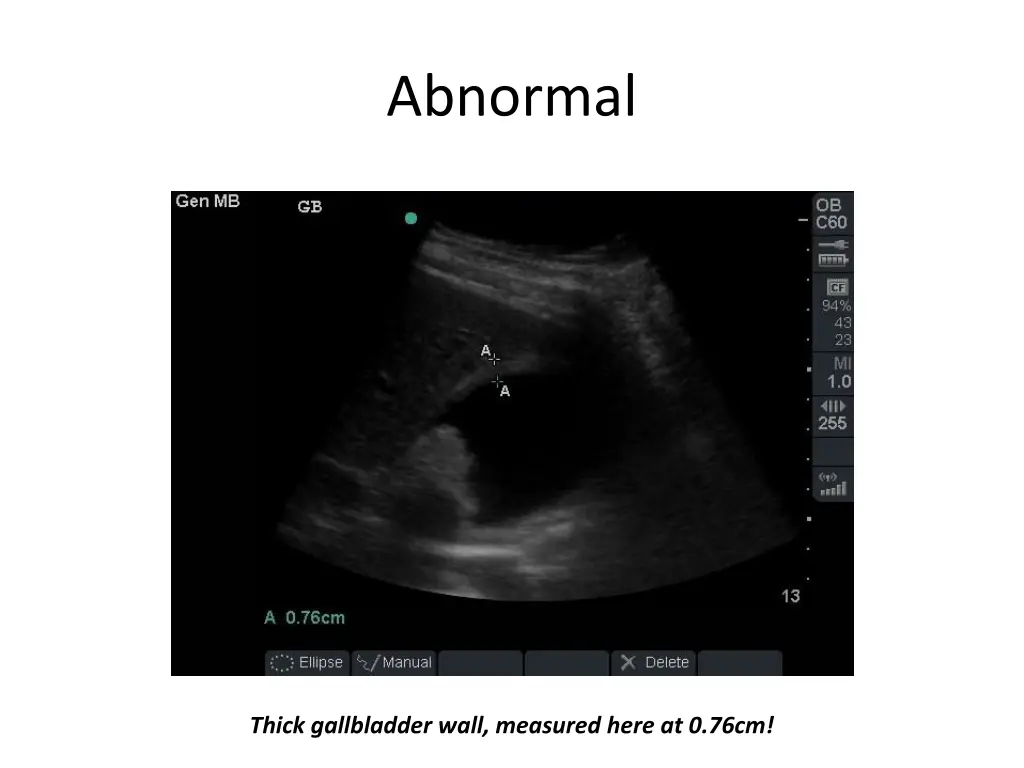 abnormal 6