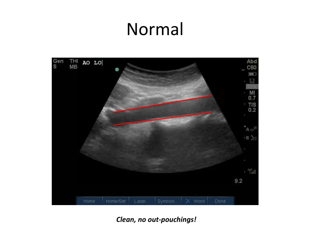 normal 1