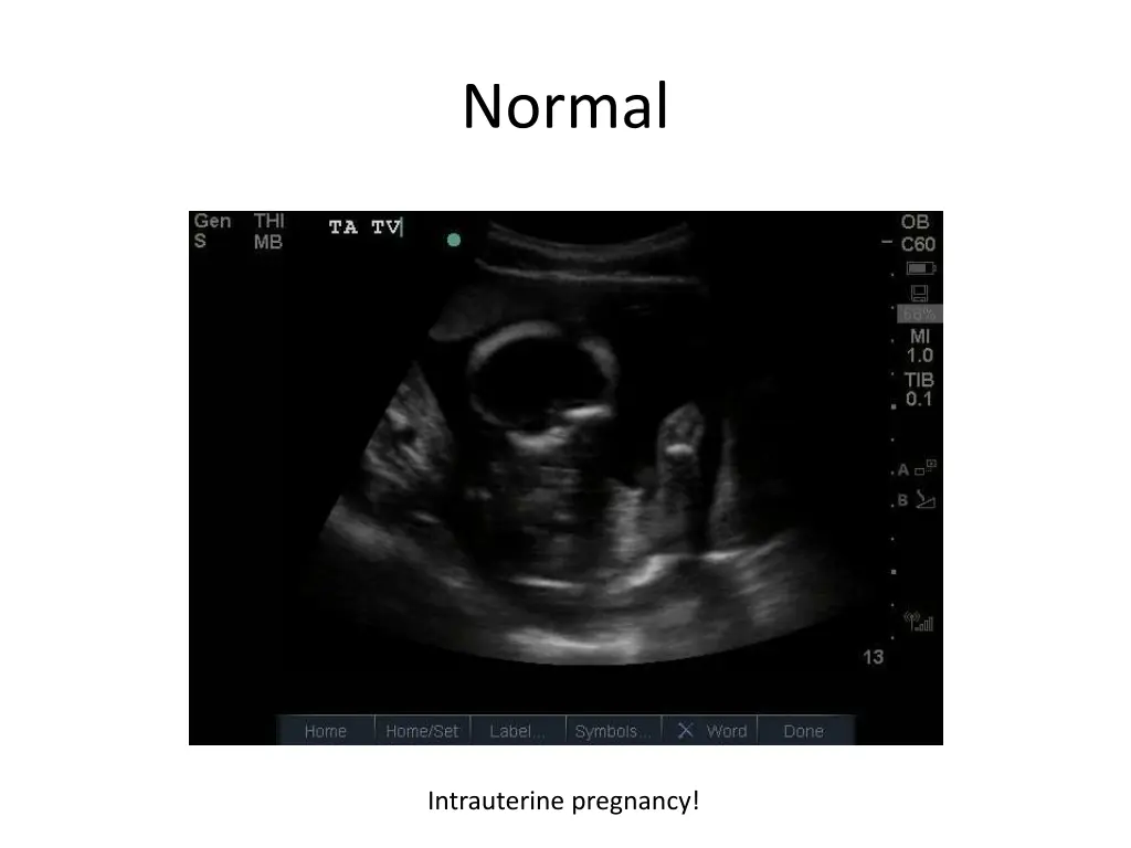 normal 2