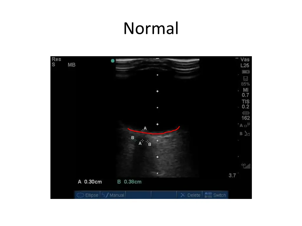 normal 3