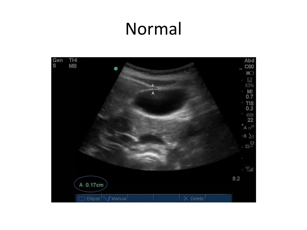 normal 5