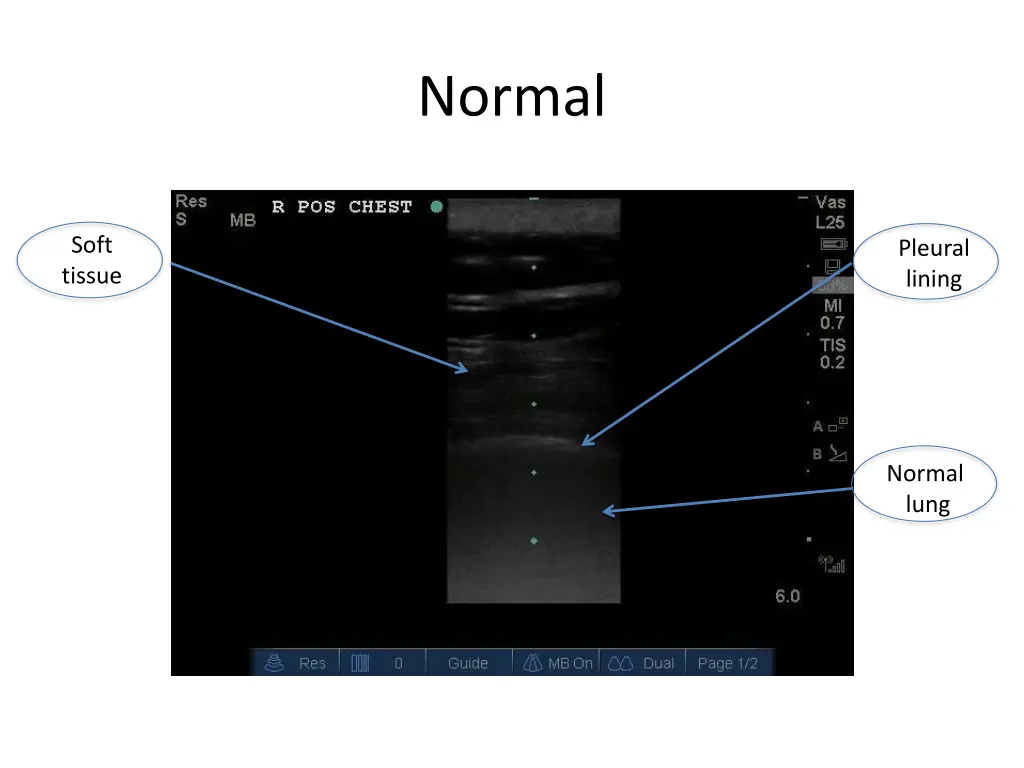 normal 6