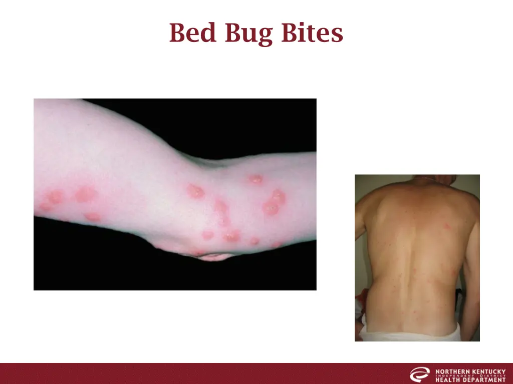 bed bug bites 1