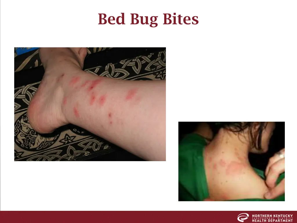 bed bug bites
