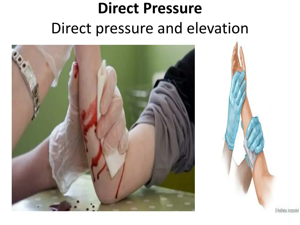 direct pressure direct pressure and elevation