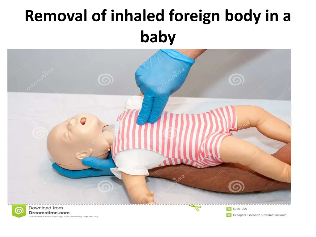 removal of inhaled foreign body in a baby