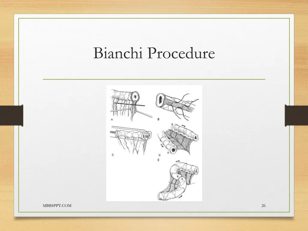 bianchi procedure