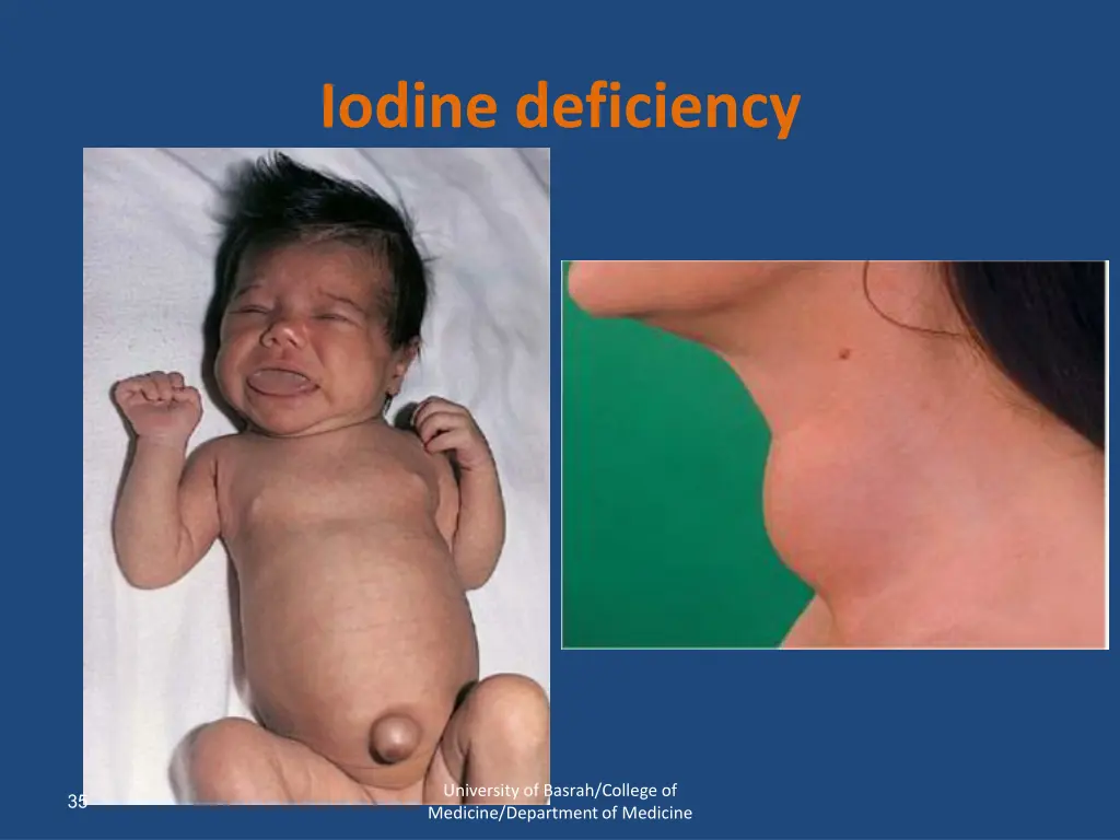 iodine deficiency 1
