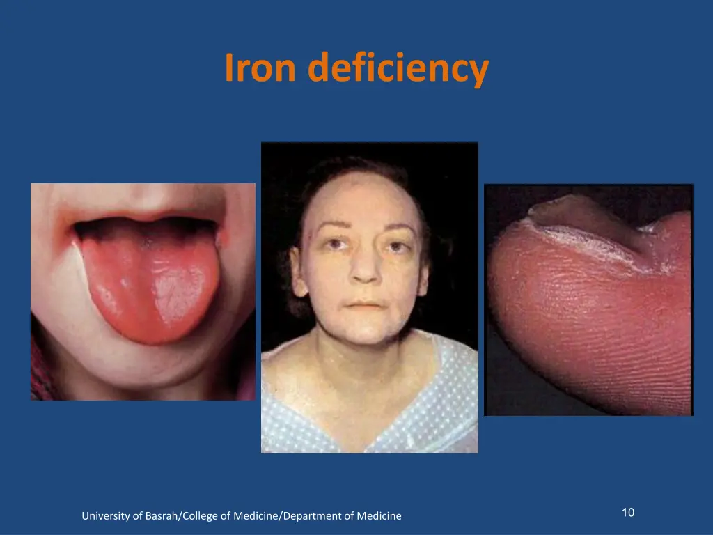 iron deficiency 1