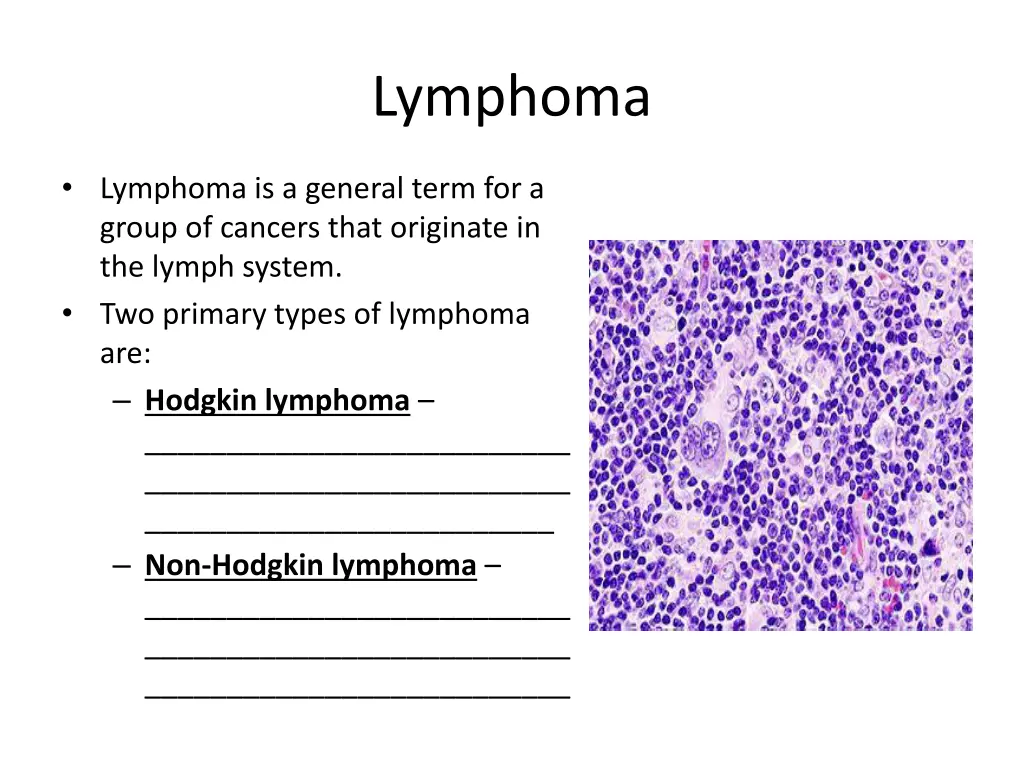lymphoma