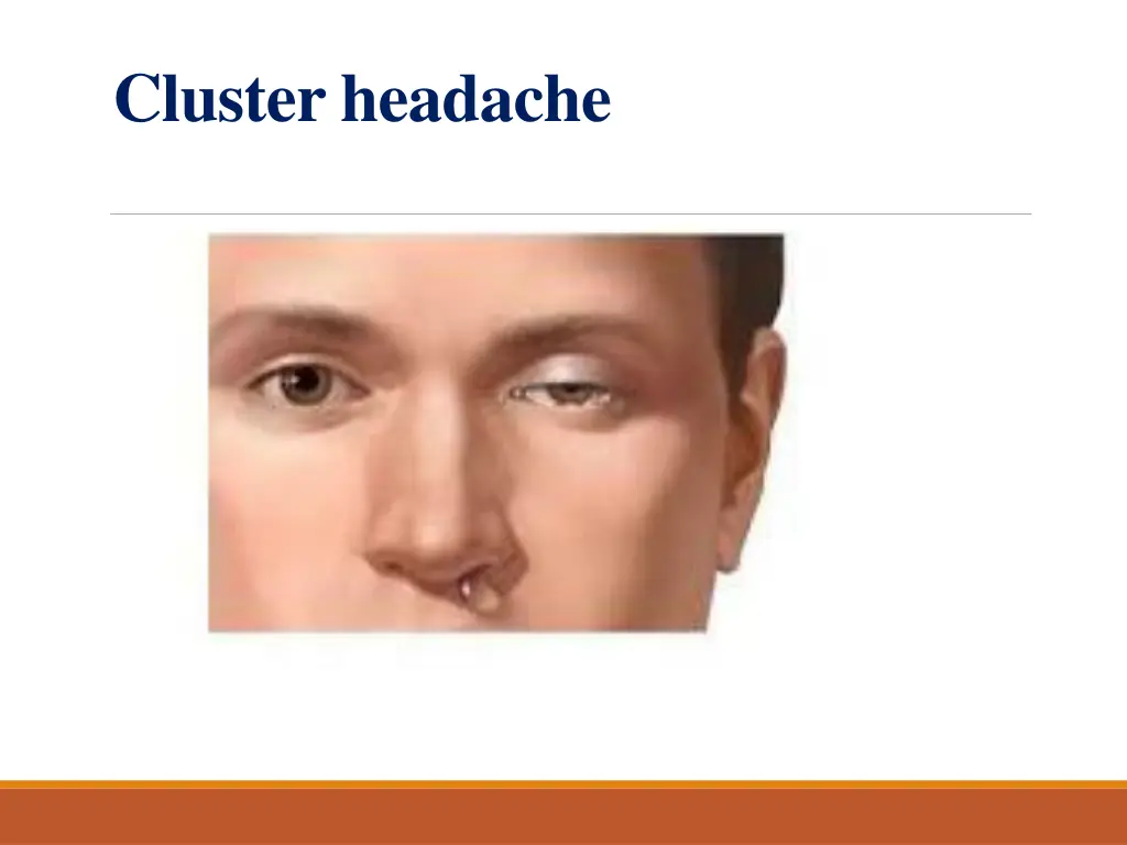 cluster headache