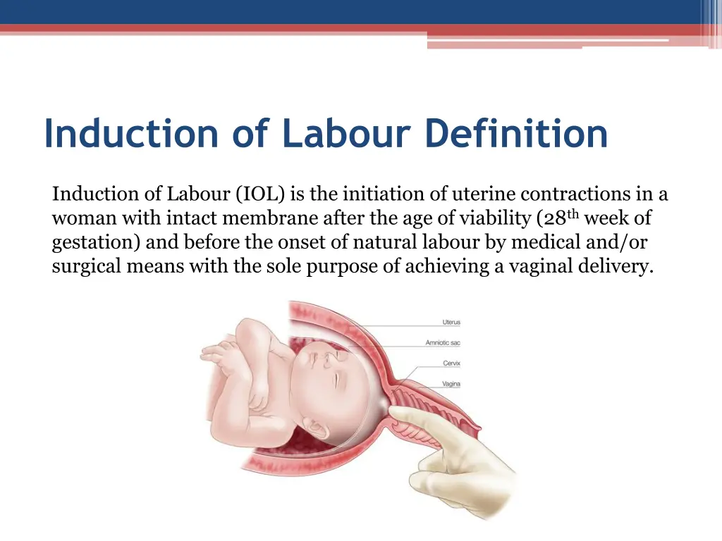 induction of labour definition