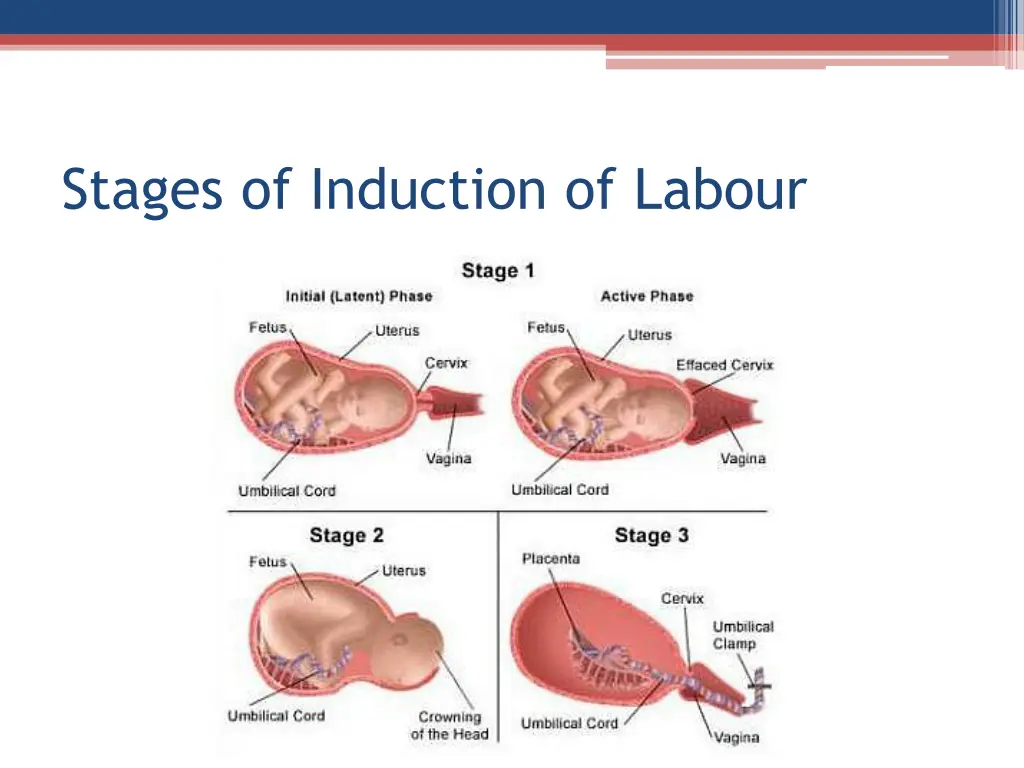 stages of induction of labour