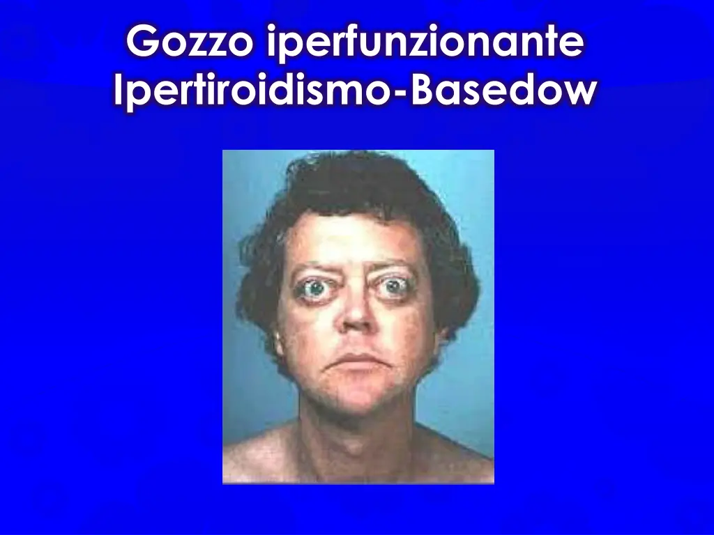 gozzo iperfunzionante ipertiroidismo basedow