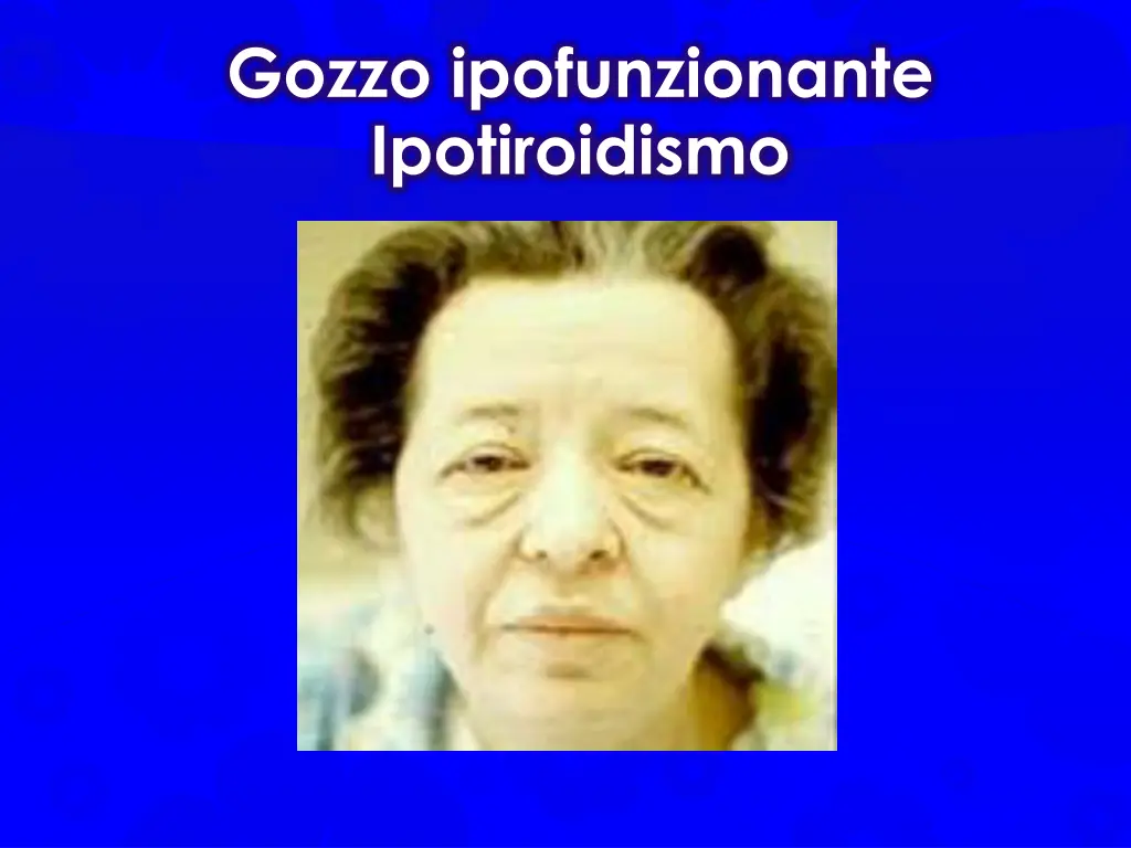 gozzo ipofunzionante ipotiroidismo