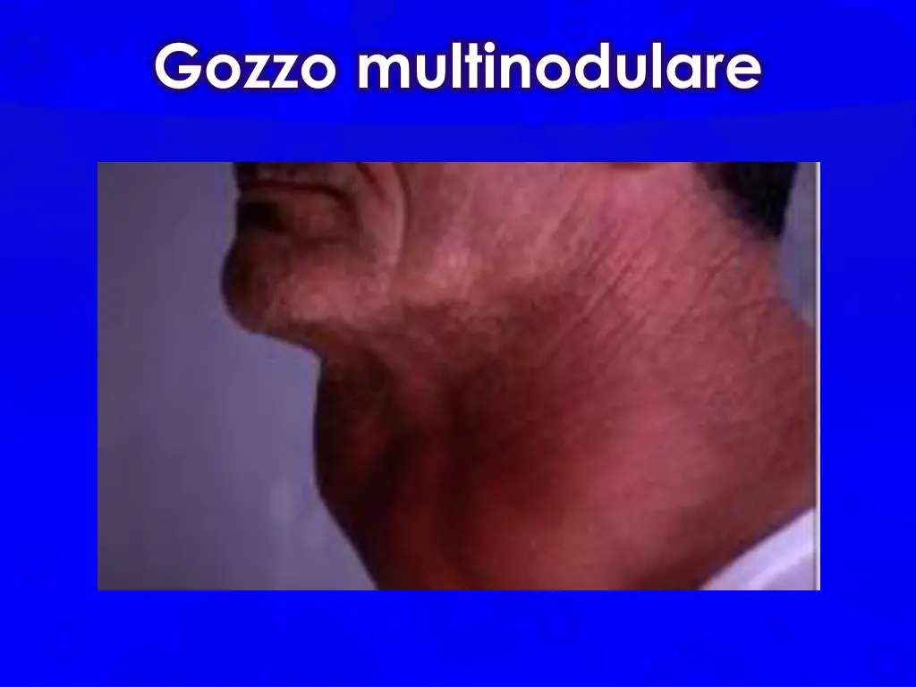gozzo multinodulare