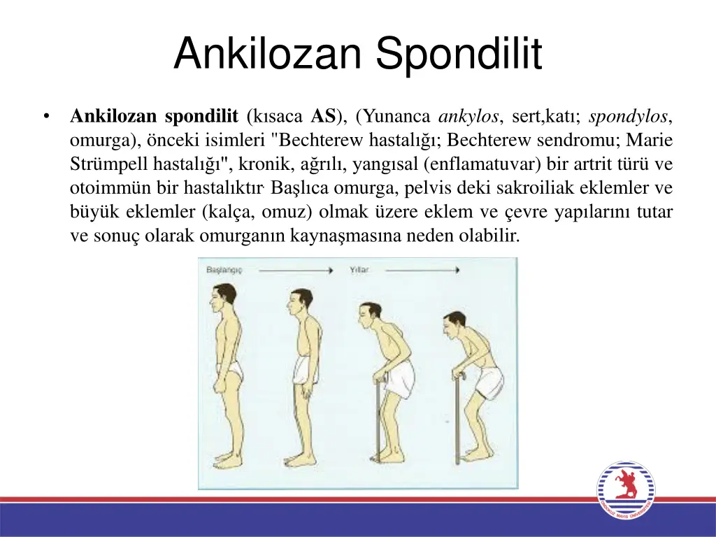 ankilozan spondilit