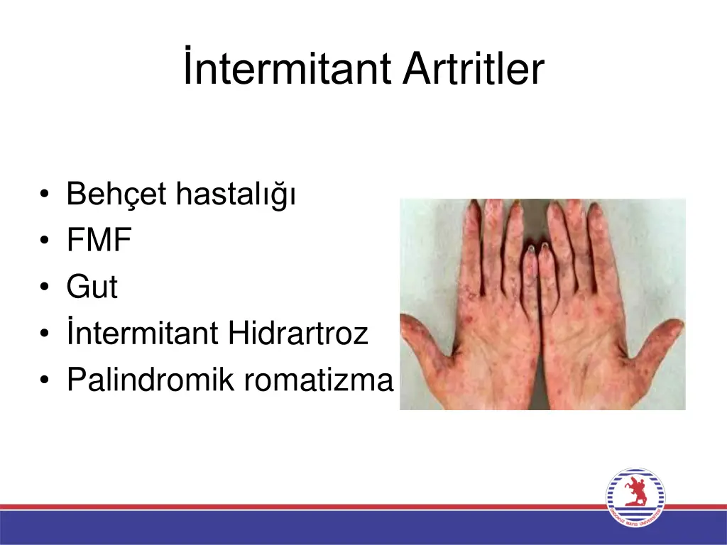 ntermitant artritler