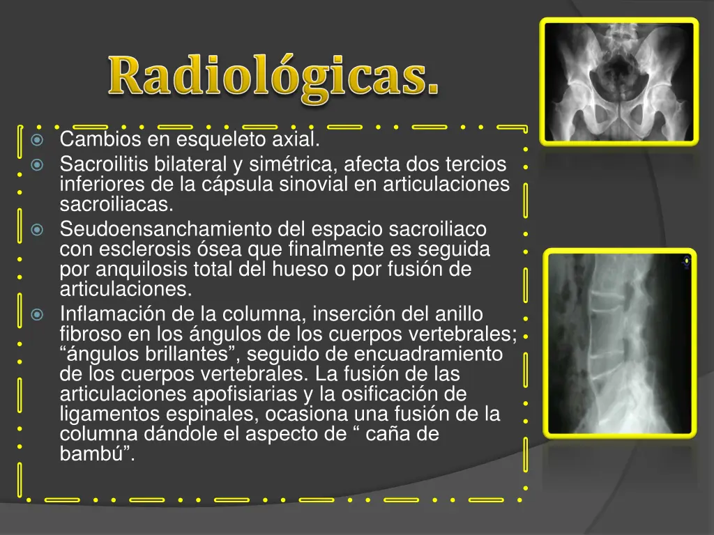 cambios en esqueleto axial sacroilitis bilateral
