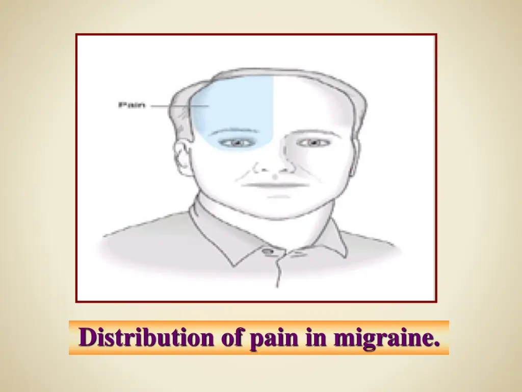 distribution of pain in migraine