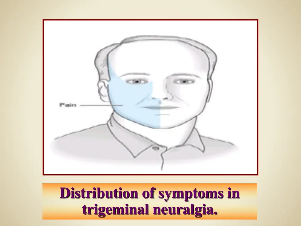 distribution of symptoms in trigeminal neuralgia