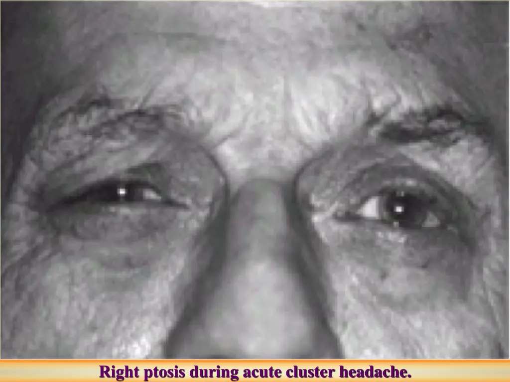 right ptosis during acute cluster headache
