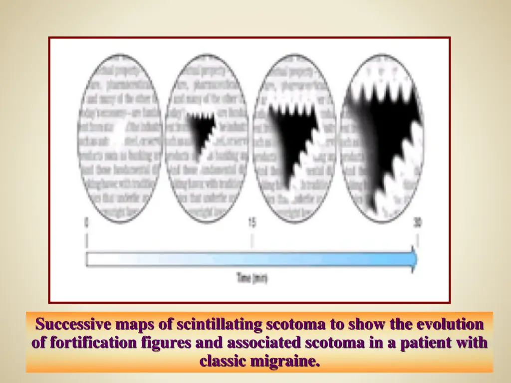 successive maps of scintillating scotoma to show