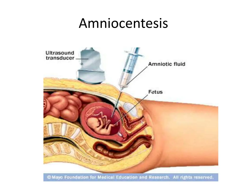 amniocentesis