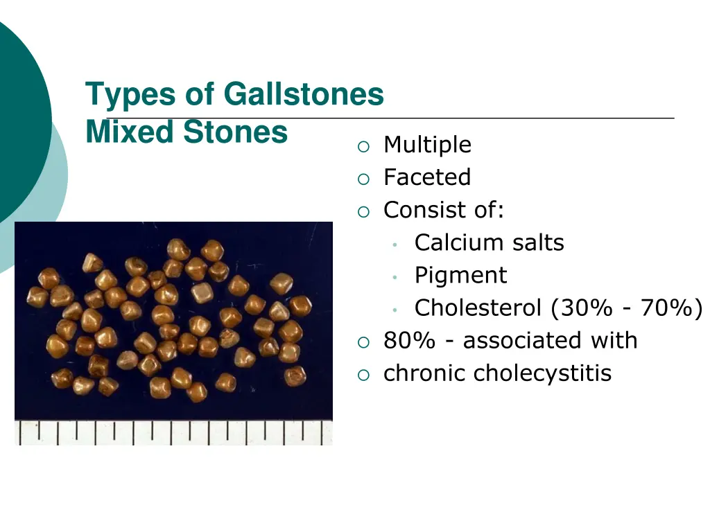 types of gallstones mixed stones