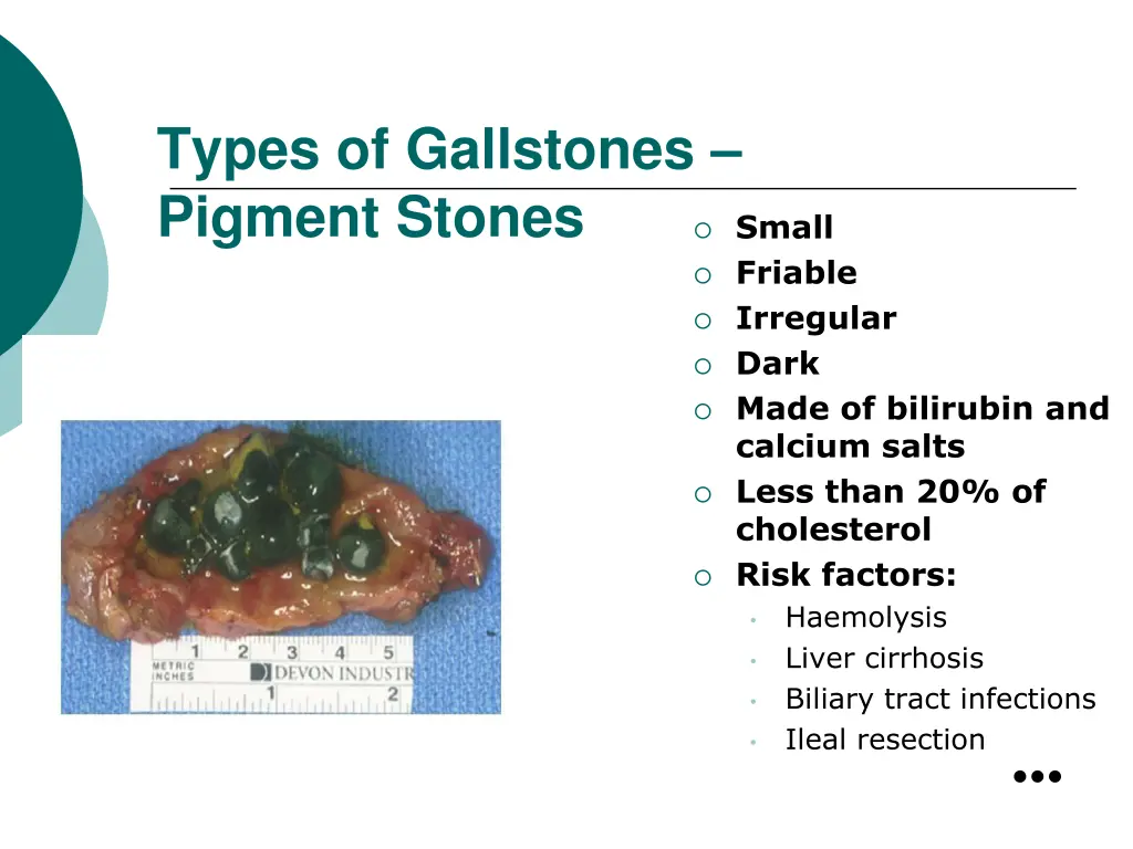 types of gallstones pigment stones