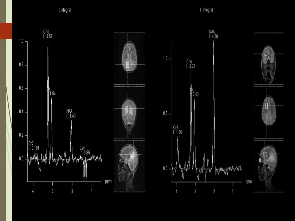 mrs of affected white matter with te 30