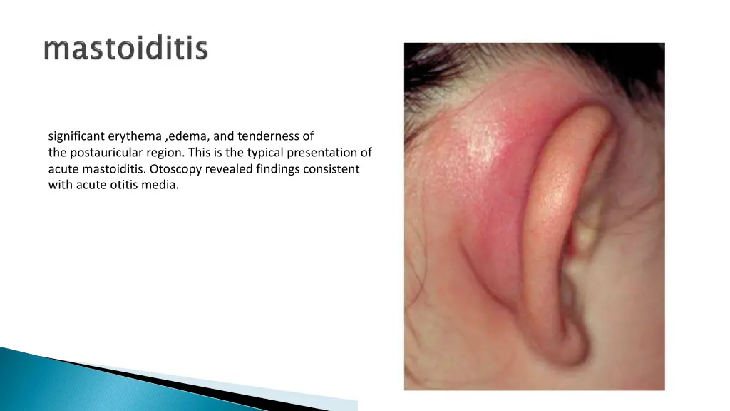 significant erythema edema and tenderness