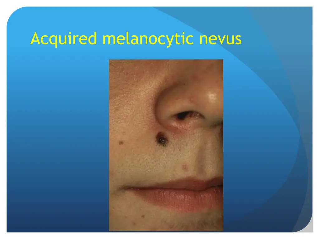 acquired melanocytic nevus