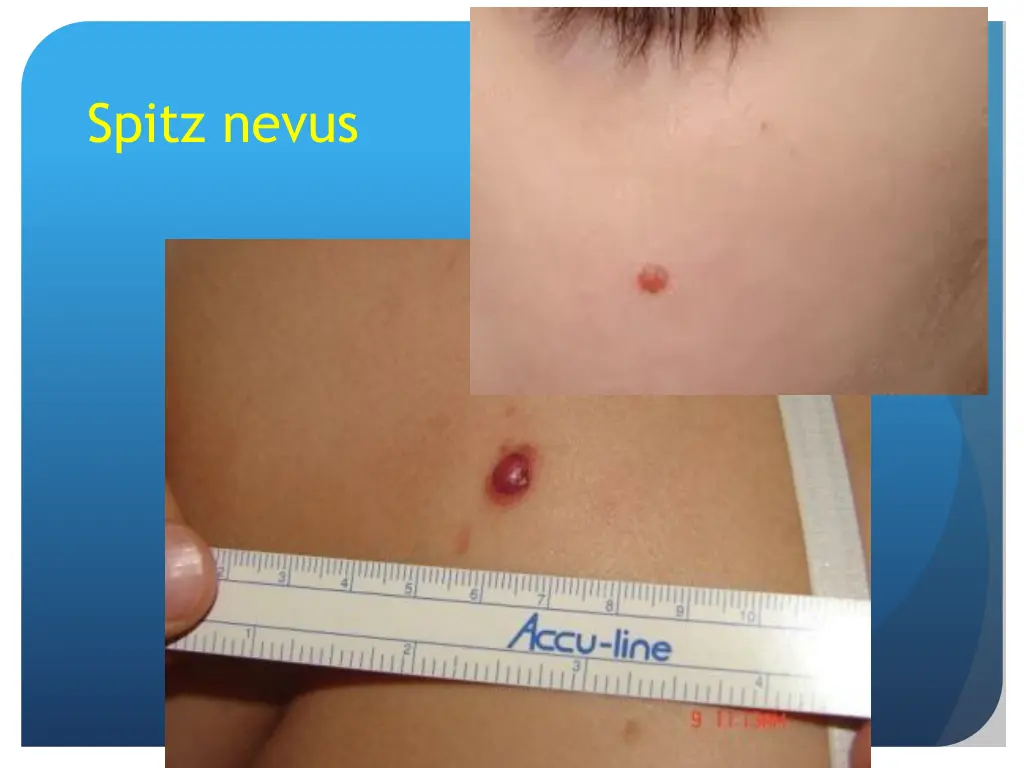 spitz nevus