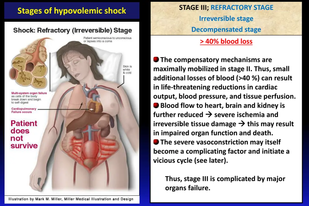 stage iii refractory stage irreversible stage