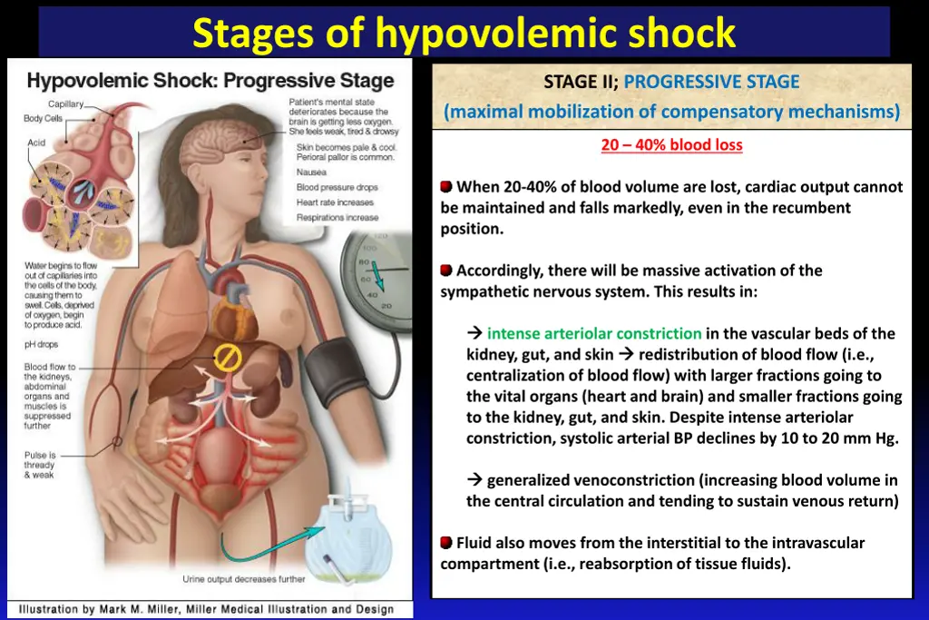 stages of hypovolemic shock 1