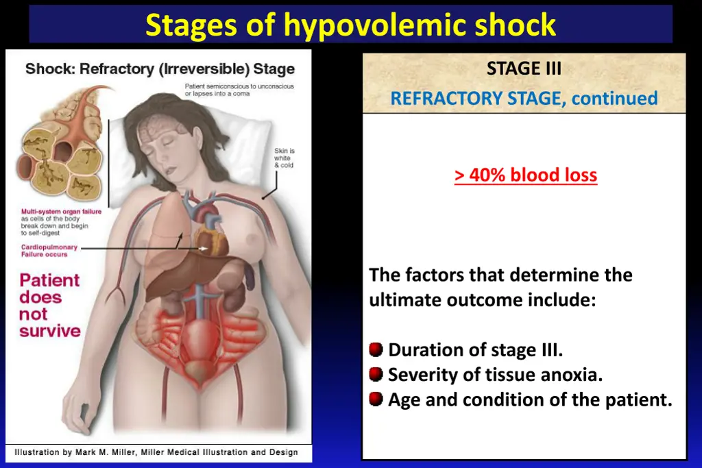 stages of hypovolemic shock 3