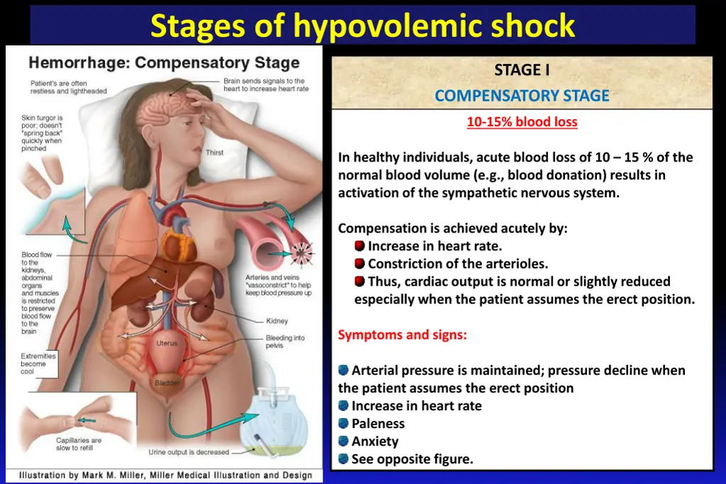 stages of hypovolemic shock